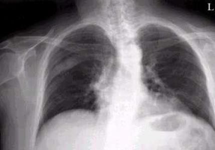 Descripción de imágenes de rayos X y análisis de campos pulmonares en una radiografía.